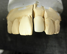 白い金属ともよばれている、軽くて、とても丈夫なものです。
スペースシャトルの外壁や人口関節などにも使われています。ただ歯のような多彩な色は出せないのでフレームをつくってその上にセラミックを盛るように使います。